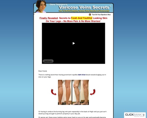 Varicose Veins Natural Alternative Home Remedies, Herbal & Treatment Help - Spider Veins Cure Ways